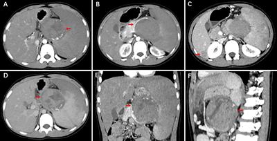 Case report: Retroperitoneal solid pseudopapillary neoplasm associated with multiple hepatic metastases